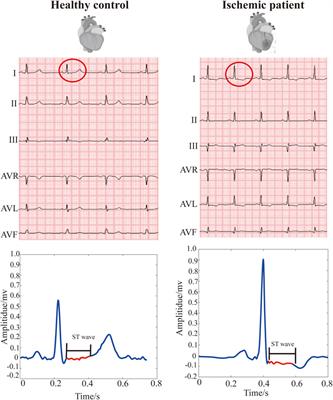 Reliable Detection of Myocardial Ischemia Using Machine Learning Based on Temporal-Spatial Characteristics of Electrocardiogram and Vectorcardiogram